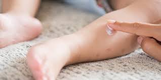 Pas de pommade antihistaminique sous la main ? Remedes Naturels Pour Apaiser Les Piqures De Moustiques