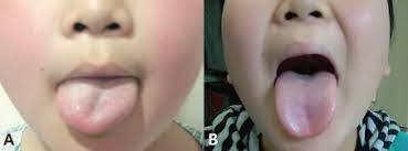 A The Patient S Tongue Showed Right Deviation At First Visit B Download Scientific Diagram