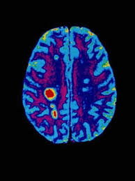 Col Mri Scan Of A Brain With Multiple Sclerosis Photographic Print Science Photo Library Art Com Brain Art Mri Scan Brain Scan