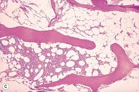 Production of red blood cells that carry oxygen to the body is affected what causes acquired pure red cell aplasia (prca)? Aplastic Anemia And Pure Red Cell Aplasia Clinical Gate