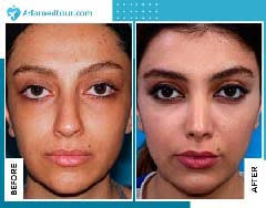 How long does it take to. How Long Does It Take To Recover From A Nose Surgery Ariamedtour