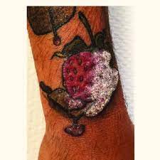 Pdf Inflammatory Reactions To Red Tattoo Inks Three Cases Highlighting An Emerging Problem