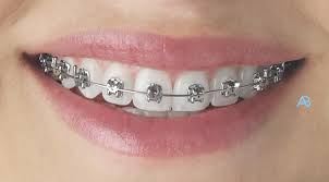 Check spelling or type a new query. Braces Ace Braces O Regan Orthodontics Teeth Straightening Ireland Braces Tullamore