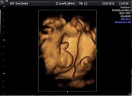 Dennoch warnen experten davor, die 3d und 4d sonographie ohne medizinische notwendigkeit durchzuführen. 3d 4d Ultraschall Babyviewing De Home Facebook