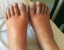 Image result for Clubbing nails feet