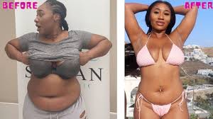The idea that the bariatric surgery will involve a significant cut across the abdomen to remove a portion of the stomach can naturally cause a worry. Revealing My New Body After Weight Loss Surgery Loose Skin Scars More 6 Months Post Op Vsg Youtube