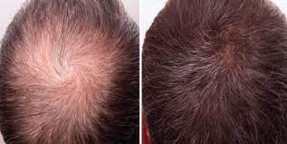 Minoxidil can cause serious health problems if absorbed systemically. Easy Tips On Using Derma Roller For Hair Loss Or Hair Regrowth