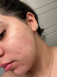 hi please I have tiny rashes