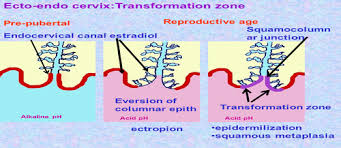 Greater than 90% of cervical cancers develop in the transformation zone (tz), a small region of metaplastic squamous epithelium at the squamocolumnar junction between endocervix and ectocervix. Histology Cc Flashcards Quizlet