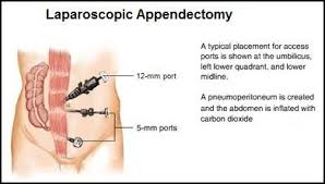 You Searched For Appendectomy Zadeh Surgical Inc Medical Transcription Appendectomy Recovery Lymphatic System
