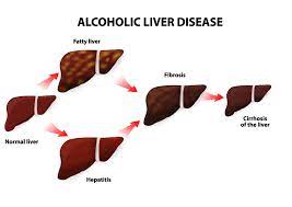 Many people with autoimmune hepatitis have no it is very important that you do not stop your treatment too early without your doctor's knowledge, as your hepatitis may return. Autoimmune Hepatitis Jackson Siegelbaum Gastroenterology