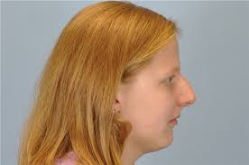 Rhinoplasty Before and After Photos by Paul Vanek, MD, FACS; Concord, OH