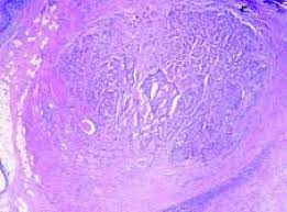 Carcinoid tumors arise from endocrine amine precursor uptake and. Tejido Tiroideo Con Foliculos Y Foco De Tumor Carcinoide Trabecular Download Scientific Diagram
