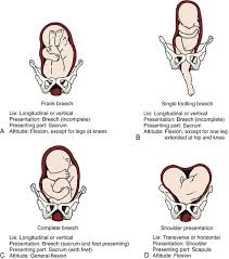 Image result for Shoulder Presentation