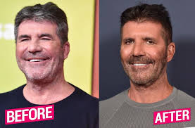 After which, he moved to dover college and left it after taking gce o levels, in which he managed to pass english language and. Simon Cowell Plastic Surgery Makeover Exposed By Top Docs