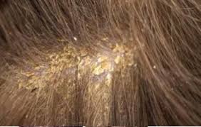 The follicles anchor each hair to your scalp. Common Scalp Conditions Causes And Treatments Nebeau