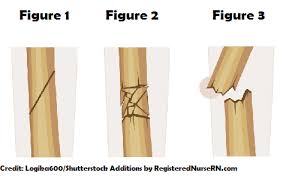 To diagnose a stress fracture, your health care provider will first ask about your general health and activities nutritional or psychological counseling can help if a stress fracture happens because of poor nutrition or an eating disorder. Fractures Nclex Questions