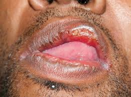 Syphilis is a sexually transmitted disease (std) caused by the bacterium treponema pallidum. Secondary Syphilis A Case Report Consult Qd