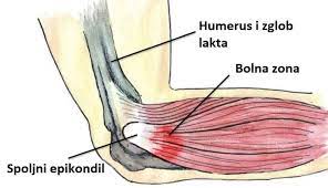 Teniski lakat je bolno stanje u području lakta koje nastaje zbog oštećenja tetiva mišića koji ispružaju šaku i prste. Teniski Lakat Golferski Lakat Epikondilitis Lakta Dr Dren Ortopedija