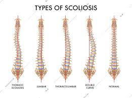 Human Spine Anatomy Scoliosis Types Set With Normal And 3 Pathological Images Realistic Medical Chart Vector Illustration Human Spine Scoliosis Anatomy