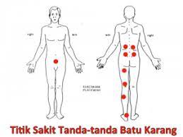 Penyakit kencing batu biasanya banyak terjadi pada usia pertengahan dan lanjut usia. Tanda Tanda Ubat Cegah Sakit Batu Karang Tanpa Bedah Facebook