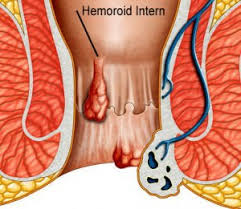 Deoarece exista nervi mai sensibili in aceasta parte a corpului, acestia sunt, in. Hemoroizi Interni Laurusmedical Hemoroizi Varice Dermatologie Gastroenterologie