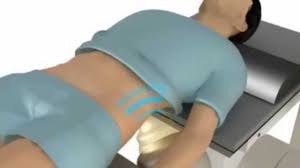 A Shocking Kidney Stone Treatment Youtube