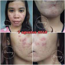 Soalnya toner some by mi ini bersifat acidic atau asam. Review Some By Mi Aha Bha Pha 30days Miracle Toner Your Wild Daisy