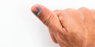 Selain daripada tidak estetika menyenangkan, ia boleh menyebabkan banyak kesan negatif psikologi dan fizikal apabila. Penyebab Kuku Warna Ungu Selain Cedera Apa Saja