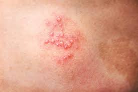 I am posting this because i have tested positive for hsv2 antibodies, and negative for hsv1. Herpes Pictures And Cold Sores Pictures
