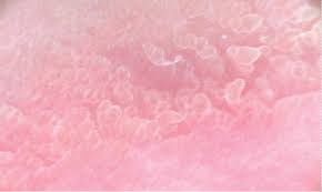 The Role Of Dermatoscopy To Differentiate Vestibular Papillae From  Condyloma Acuminate In A Pregnant Woman