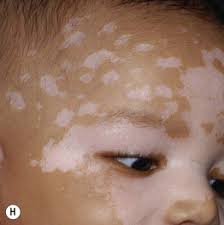 Image result for Postinflammatory Hypopigmentation