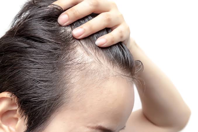 Pérdida de cabello masculina