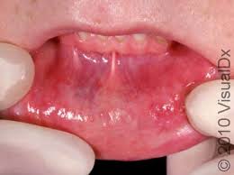 Image result for Canker sores roof of mouth