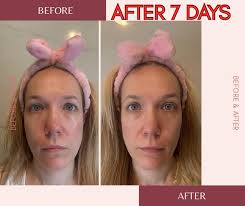 Neo-filler results after 12 weeks