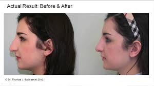 I finished it on wednesday evening. Why Does It Take A Year To See Full Results From Rhinoplasty
