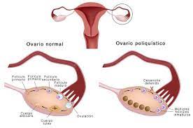 Algunos De Los Remedios Caseros Mas Eficaces Y De Confianza Para El Sindrome De Ovario Poliquistico Incluyen El Uso De La Palma Health And Wellness Health Pcos