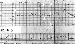 Image result for Late Deceleration