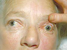 Exophthalmos (also called exophthalmus, exophthalmia, proptosis, or exorbitism) is a bulging of the eye anteriorly out of the orbit. Exophthalmus Wikipedia