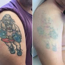 When i started working for tannan plastic surgery i discovered the surgical procedure of tattoo excision and it saved me the money and trouble of laser removal. Pin On Before After Photos Picosure Laser Tattoo Removal