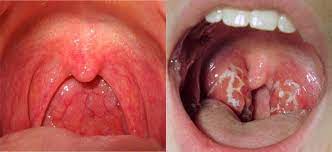 Coming into contact with these. Sore Throat Vs Strep Throat Difference And Comparison Diffen
