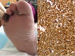 If detected in the early stages, foot cancer can be treated effectively. Acral Melanoma Mimicking Toe Gangrene In Diabetic Foot European Journal Of Vascular And Endovascular Surgery
