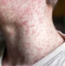 Image result for measles