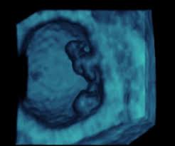 La fotografía de un embrión de siete semanas, producto de un aborto espontáneo, ha conmovido las redes sociales al evidenciar cómo luce un concebido a tan temprana edad. Desarrollo Del Feto Semana 7 Brazos Y Piernas Ya Se Esbozan