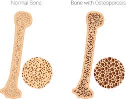 osteoporosis clinic treatment in hoover birmingham al osteoporosis clinic treatment in