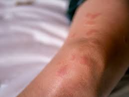 This can damage many parts of the body, including the joints, skin, kidneys, heart. Kollagenosen Bindegewebserkrankungen