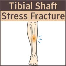 Image result for Tibia Stress Fracture