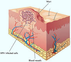 Diagram Of Hpv Wart Reading Industrial Wiring Diagrams