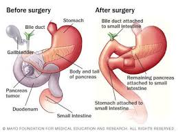 Whipple Procedure Whipple Procedure Medical Surgery