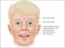Fetal Alcohol Spectrum Disorder Fasd Fetal Alcohol Fetal Alcohol Syndrome Fetal Alcohol Spectrum Disorder